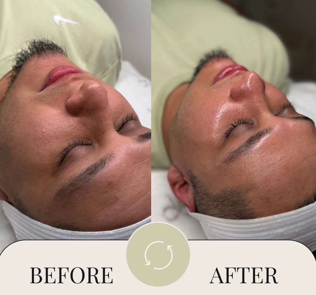 Client before and after facial treatment result